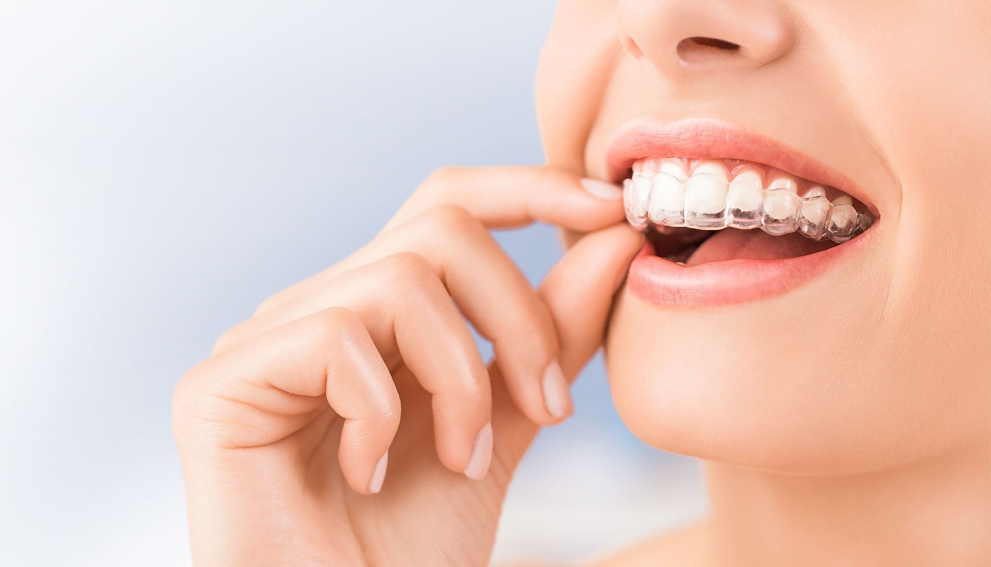 Clear aligner tray used to straighten teeth discreetly